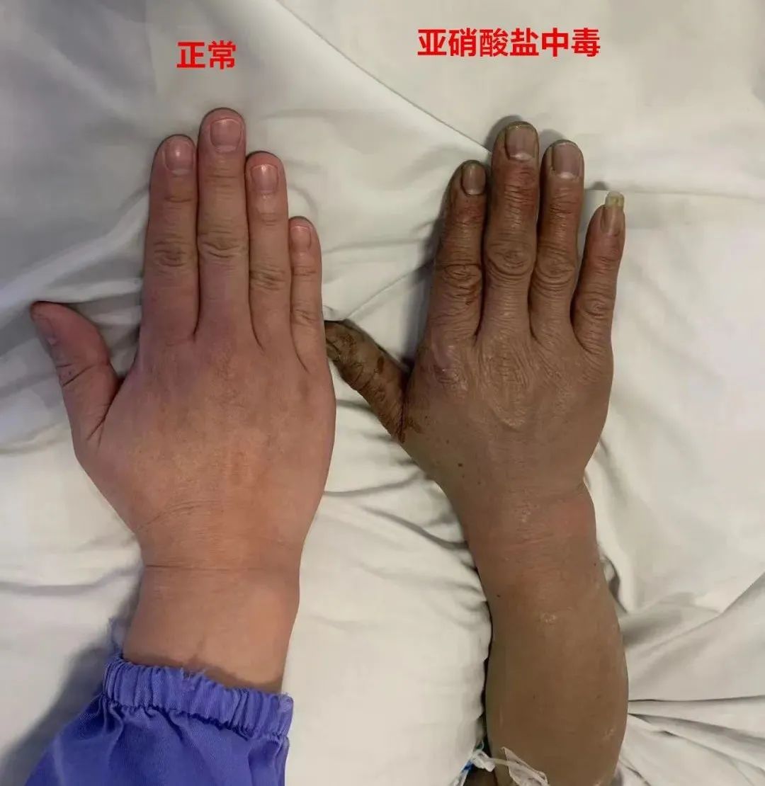 入院后,急诊医生检查发现,洪先生嘴唇发黑,双手指甲发紫,怀疑其发生了